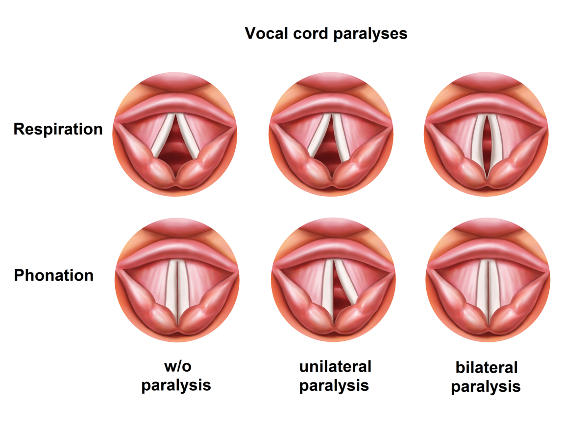 Vocalcordparalyses